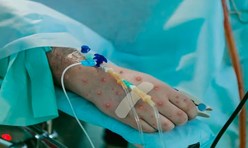 Detectan primer caso humano mortal de la “viruela de Alaska”