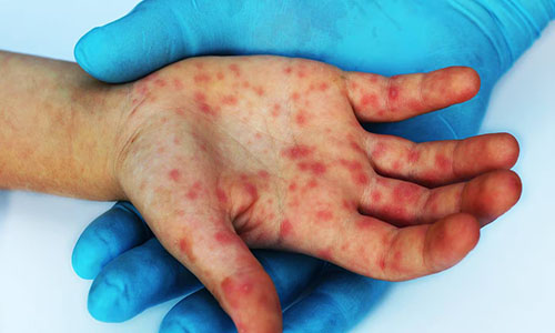Salud descarta contagios de sarampión transmitidos localmente