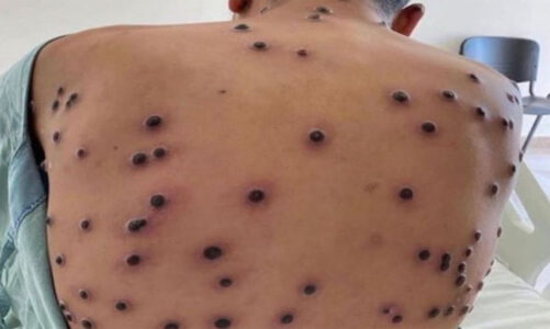 Tres virus que podrían desencadenar una nueva crisis sanitaria