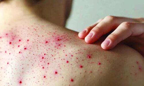 Sarampión suma más de 11 mil casos en el país